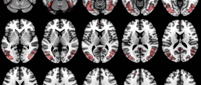 大脑扫描的黑色、白色和红色图像由麦考斯兰中心呈现。