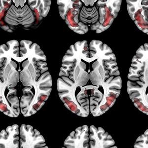 多个黑白扫描大脑的红色亮点。